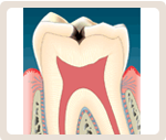 エナメル質内までの虫歯