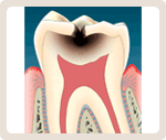 象牙質まで進行した虫歯