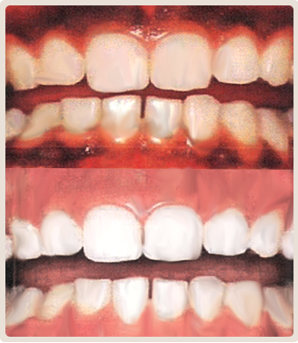 歯肉ホワイトニング イメージ