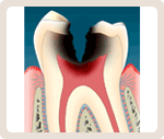 歯髄まで進行した虫歯